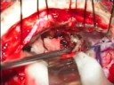 Brain Stem Tumor Operation Brain Stem Tumor Operation
