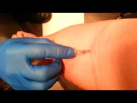 how to perform iv insertion