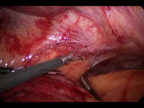 how to tell if hernia repair failed