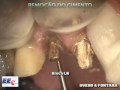 Remoção de Núcleo Fundido – Equipe de Endodontia de Campinas