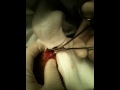 Pimple pop part 3
