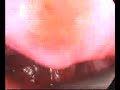 Laparoscopic treatment of a recurent tubo ovarian abscess