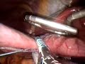 Sleeve Gastrectomy Situs Inversus Totalis