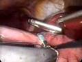 Sleeve Gastrectomy Situs Inversus Totalis