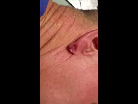 how to drain infected ear