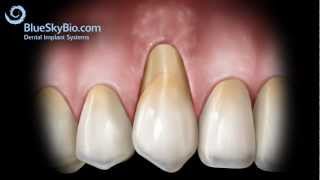 Gingival Graft Alloderm