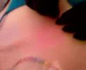 My 1st Microdermal