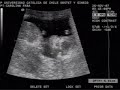 Este es una ecografía de nuestra guagua (aun sin nombre). Son exactamente 13 semanas y 3 días.