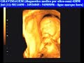 GRAVIMAGEM 04 (ultra-som obstetrico em terceira dimensão 4D) GRAVIMAGEM 04 (ultra-som obstetrico em terceira dimensão 4D)