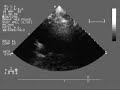 heart color doppler test