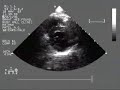 heart color doppler test