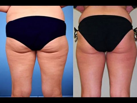 how to treat cellulite