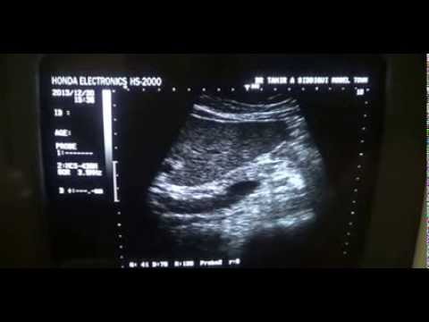 how to locate cbd on ultrasound