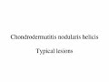 Chondrodermatitis Nodularis Helicis Appearance