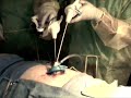 Laparoscopic SinglePort Partial Nephrectomy in Porcine Model