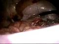 Laparoscopic SinglePort Partial Nephrectomy in Porcine Model