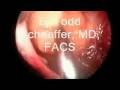 Removal of Neck Lipoma Removal of Neck Lipoma