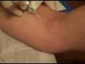 Todd's HUMAN ANTIBODIES Treatment!!!