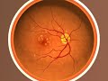 video-illustration-of-agerelated-macular-degeneration-amd.html
