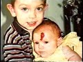 Hemangioma Forehead/TLC/Part 1