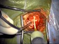 Microvascular Decompression for Treatment of Trigeminal Neuralgia 3