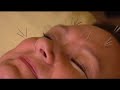 Acupuncture: Mei Zen Acupuncture: Mei Zen