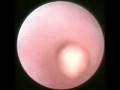 videos de sialendoscopy