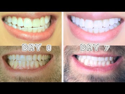 how to whiten dental crowns