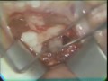 Removal of an impacted mandibular canine