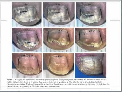how to treat onychomycosis