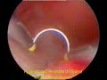 Hysteroscopic Resection of Fibroid