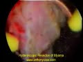 hysteroscopic-resection-of-fibroid.html