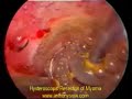 Hysteroscopic Resection of Fibroid