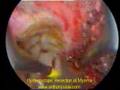 Hysteroscopic Resection of Fibroid