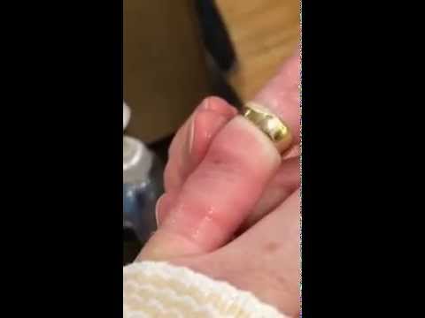 how to get a ring off a swollen finger