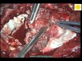 Neurosurgery Video Lateral Sphenoid Wing Meningioma