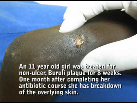 how to self diagnose an ulcer