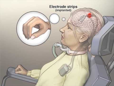 Implanted Brain–Computer Interface in a Locked-In Patient