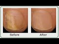 Toenail Fungus Cures