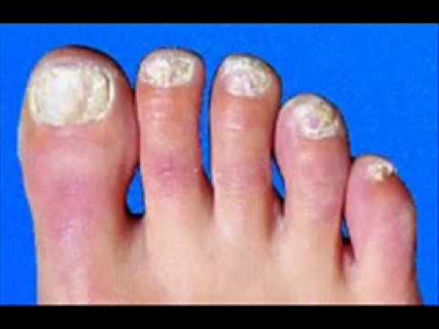 how to cure toenail fungus uk