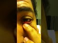 Popping an Eye sty