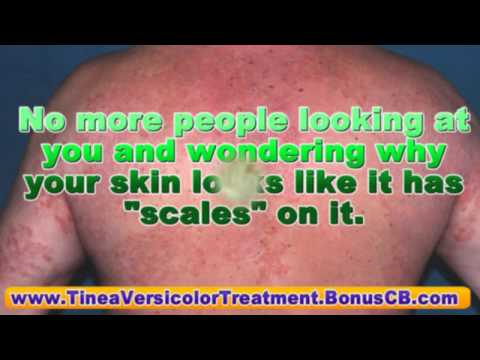 how to treat skin fungus