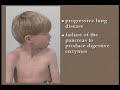  Cystic Fibrosis CF Foundation medicine United States help patients parents sweat test