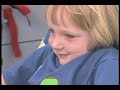 Cystic Fibrosis Foundation: Sweat Test Cystic Fibrosis Foundation: Sweat Test