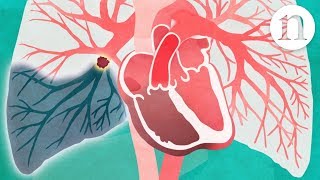 Pulmonary embolism: The route to recovery