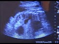 The Birth of Amelia Rose