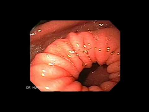 Endoscopy - Upper Gastrointestinal Endoscopy The term