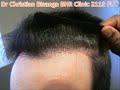 BHR Clinic 2113 FUT Hair Line BHR Clinic 2113 FUT Hair Line