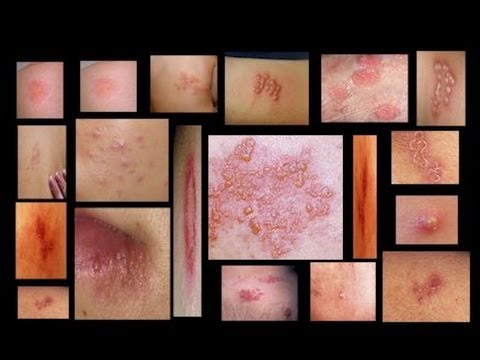 how to cure genital herpes