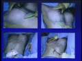 Part 2 Transumbilical Breast Augmentation Explained and Demonstrated by Neal Handel, MD